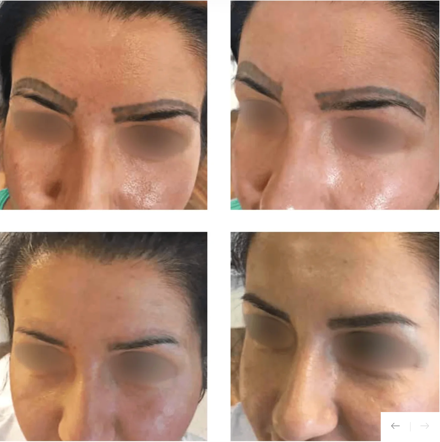 Nd Yag Laser Removal Training 1 Day - 15 October 2025