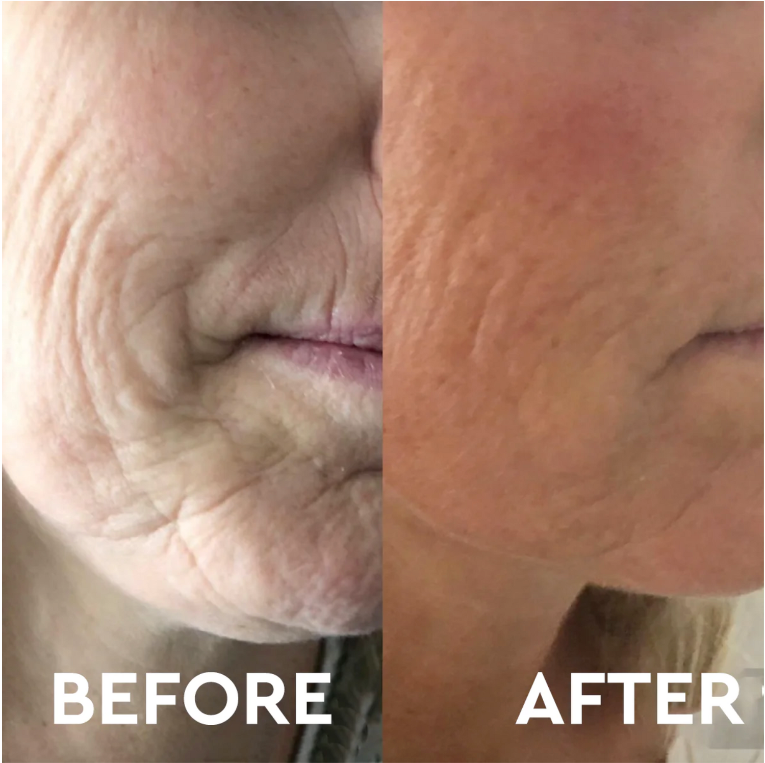 Anti Aging Micro Needling Training - 13 October 2025 Monday