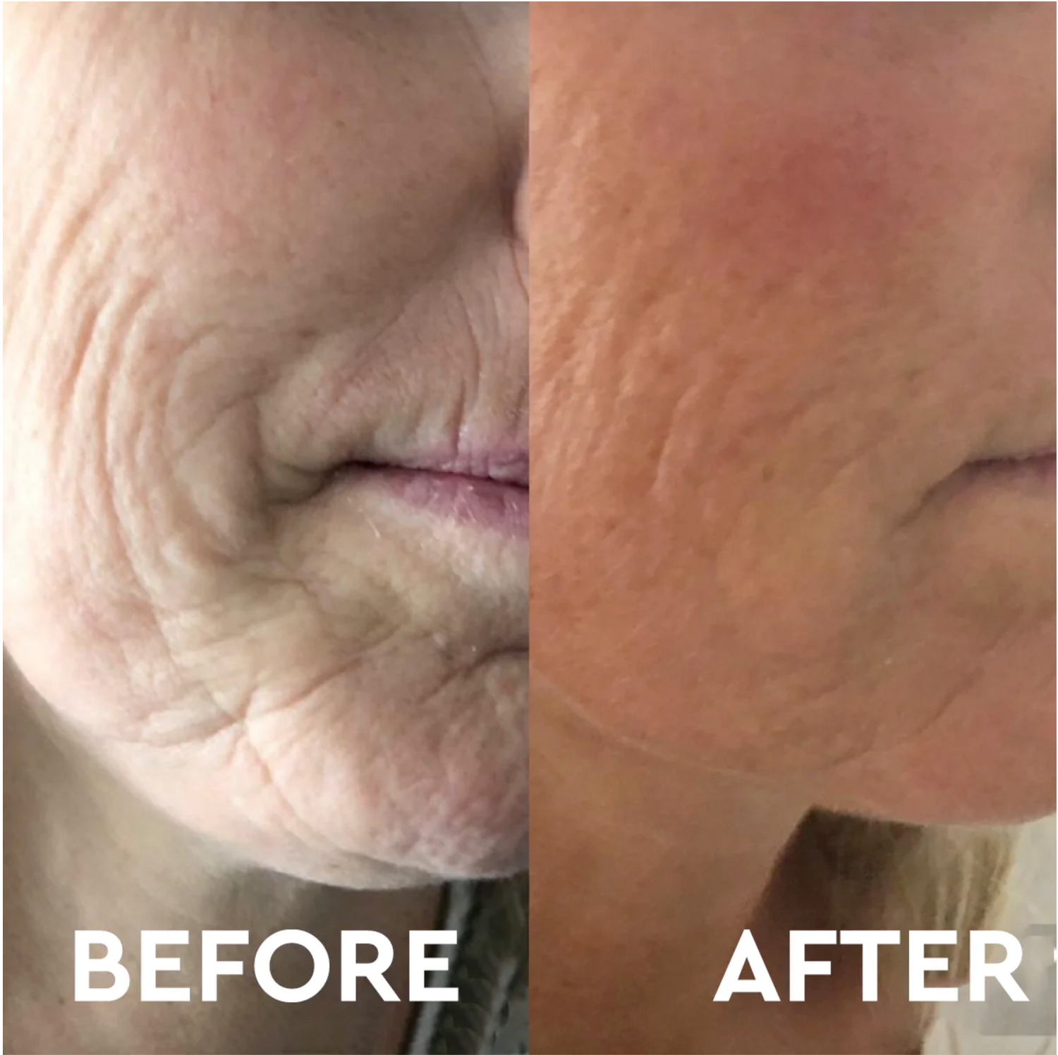 Anti Aging Micro Needling Training - 25 April 2024 Thursday