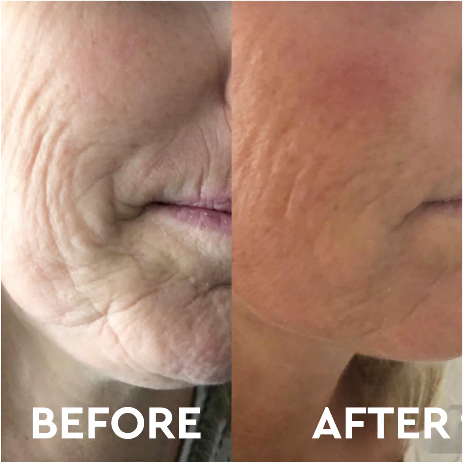 Anti Aging Micro Needling Training - 13 October 2025 Monday
