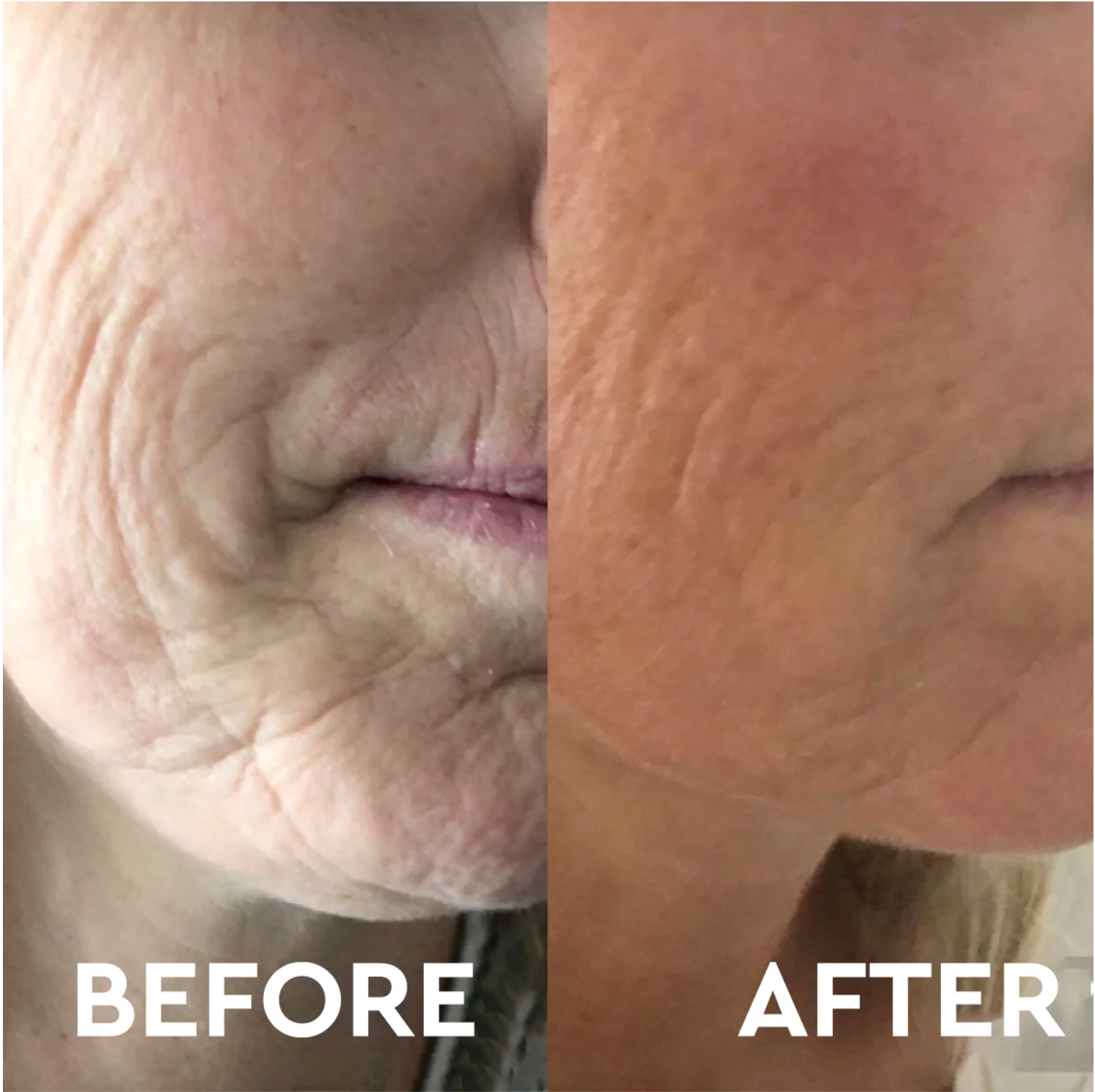 Anti Aging Micro Needling Training - 25 April 2024 Thursday