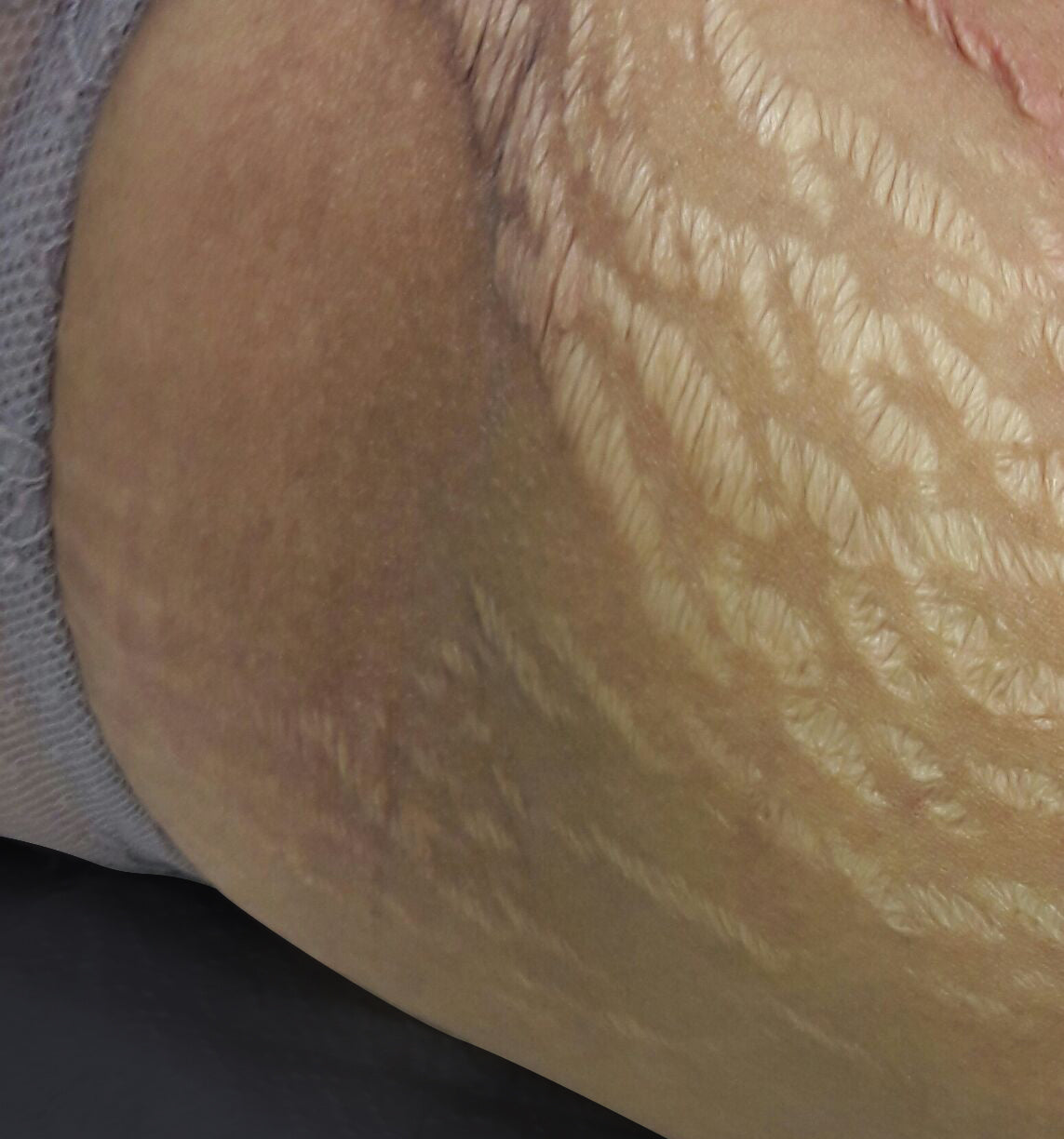 Stretch Marks Training