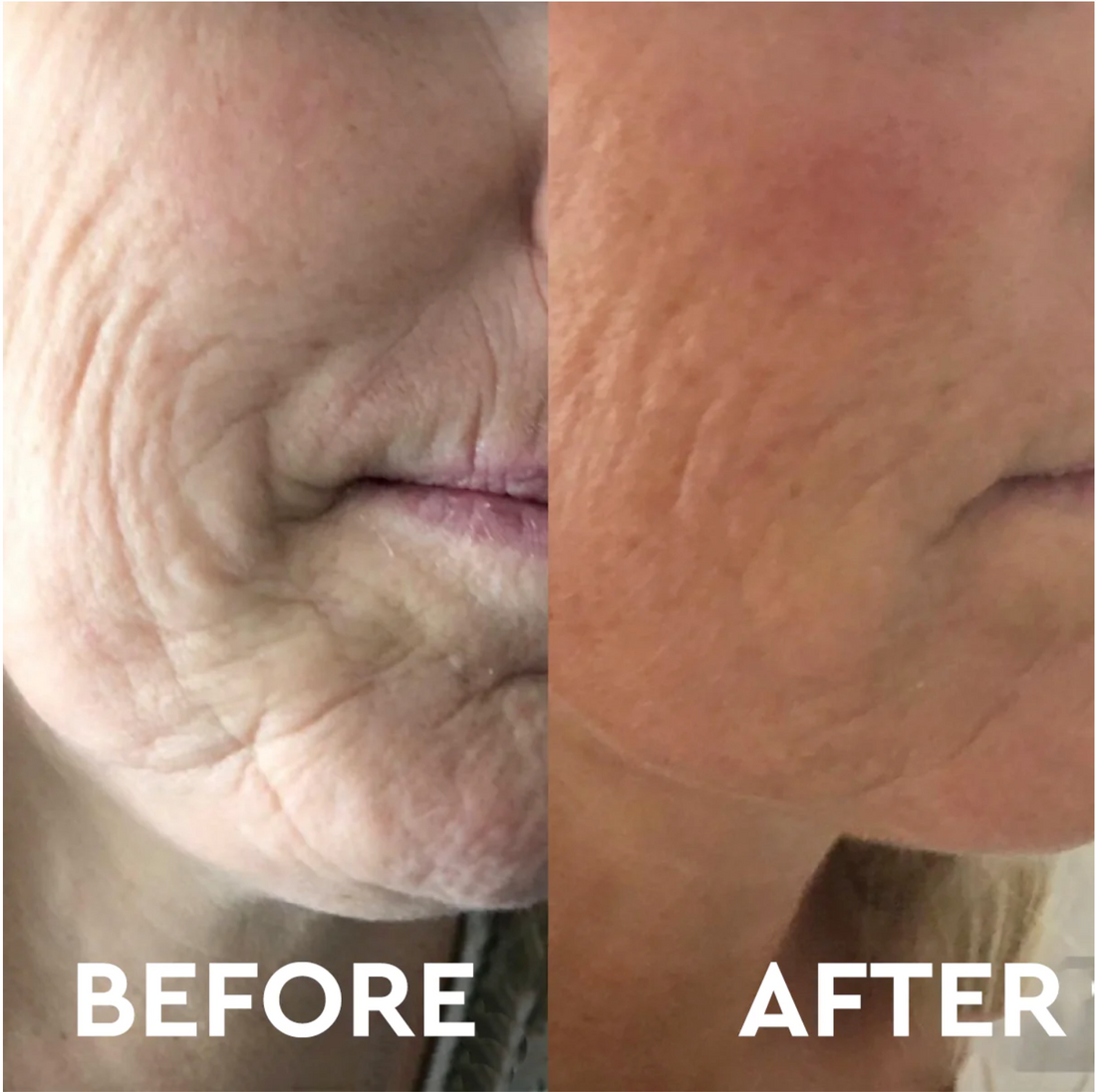 Anti Aging Micro Needling Training - 13 October 2025 Monday