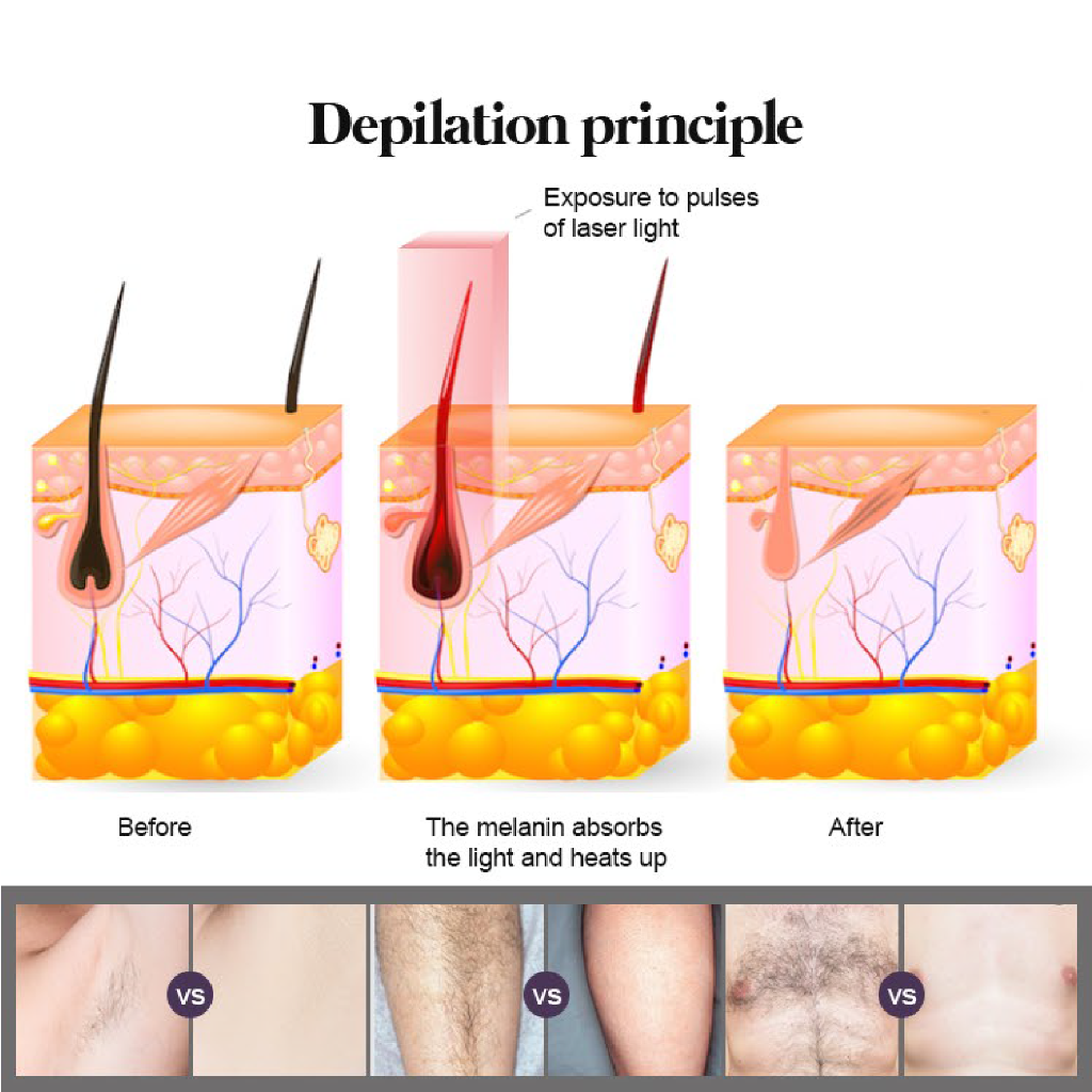 Diode Ice Laser Hair Removal
